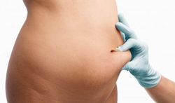 Liposuccion : un peu de sport, c'est essentiel