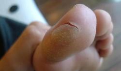 Ampoules aux pieds : les éviter et les soigner