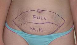 Correction de la paroi abdominale