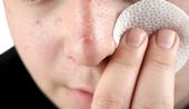 Acné : la guerre des boutons n'aura pas lieu !