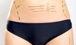 Liposuccion ou liposculpture