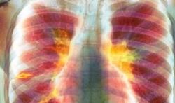 Tuberculose : les points-clés
