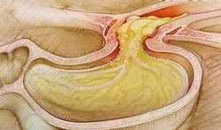 Le reflux gastro-oesophagien ou RGO