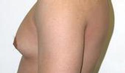 Gynécomastie (hypertrophie des seins chez l’homme)