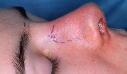 Correction du nez (Rhinoplastie)