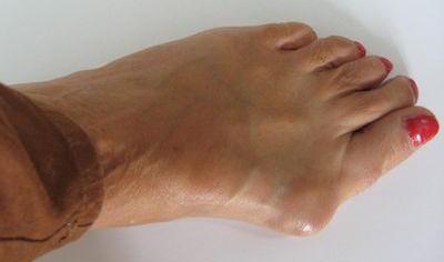 Quelle prière aidera du psoriasis