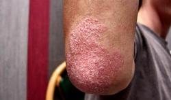 Lux les fragments le psoriasis et avec